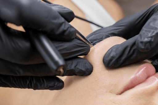 Electrolysis hair removal remains the only medically recognised method of permanent hair removal, making it the gold standard for patients dealing with facial hair, grey or white hairs.